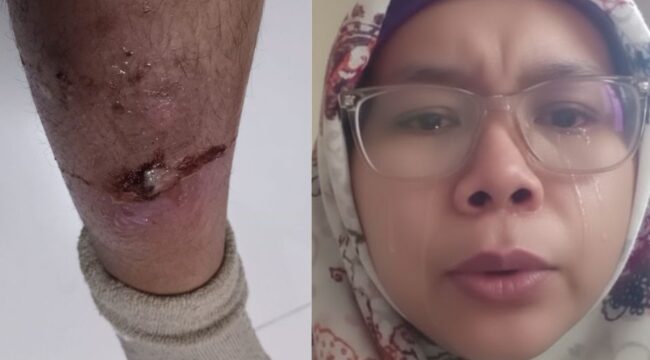 Lela Safitri menangis menahan sakitn di betisnya